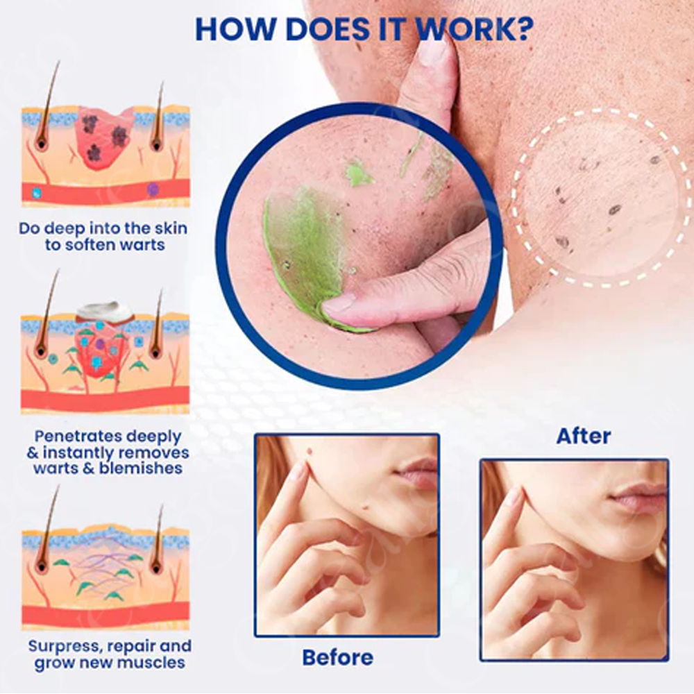 NatureErase: Erase Unwanted Marks in 7 Days Without Surgery, Pain, or $650 Doctor Bills