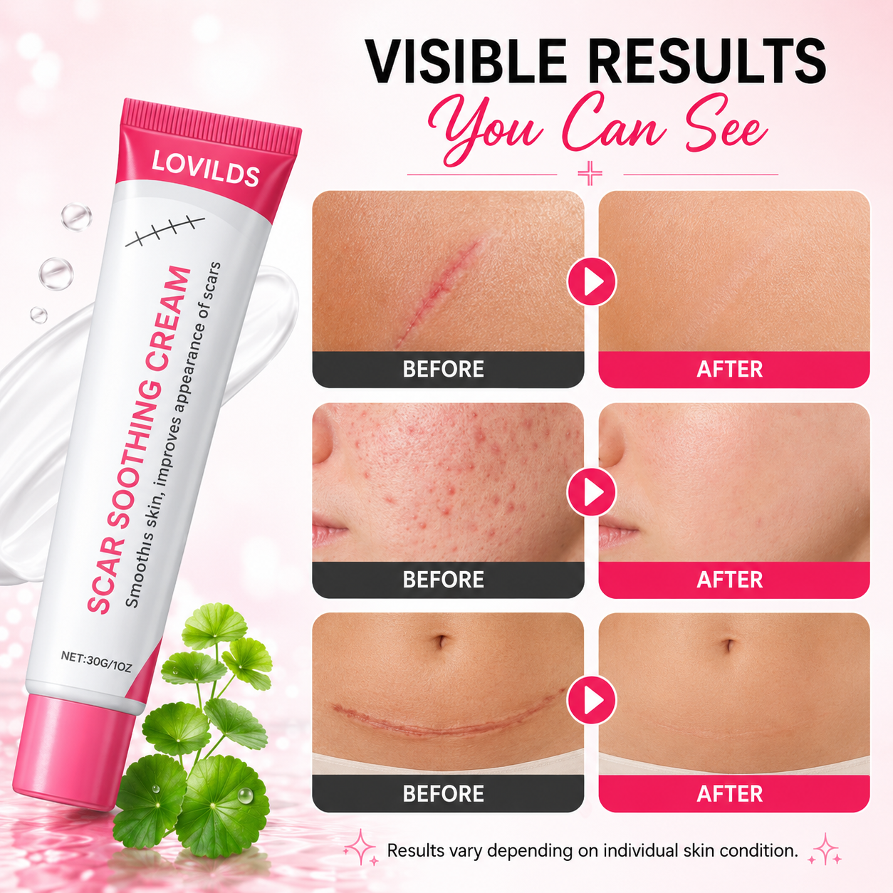 🔥LAST DAY Buy 1 Get 1 Free🔥Scar free wart removal cream